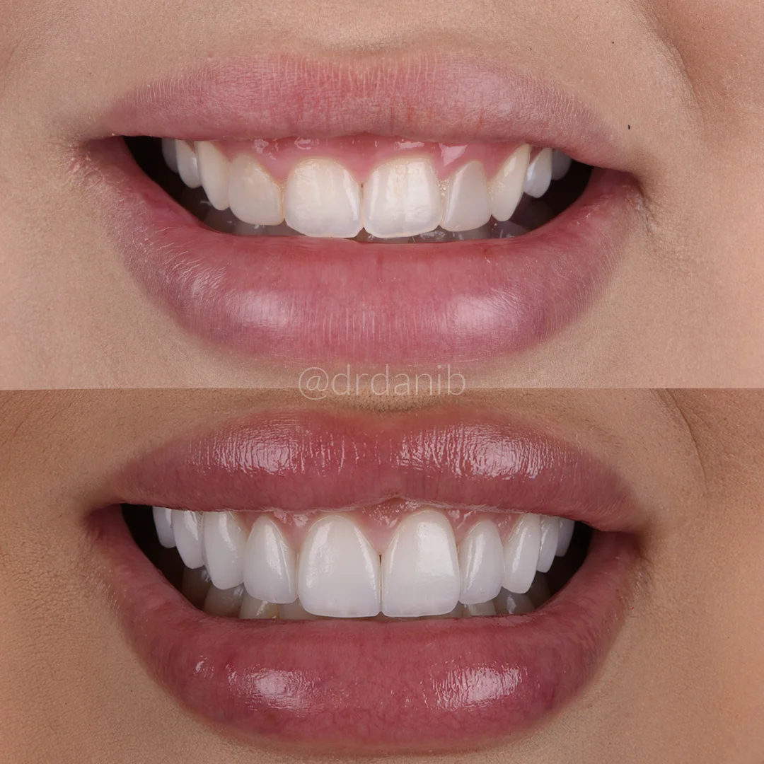 Veneers los angeles Before & After By Dr. Dani B