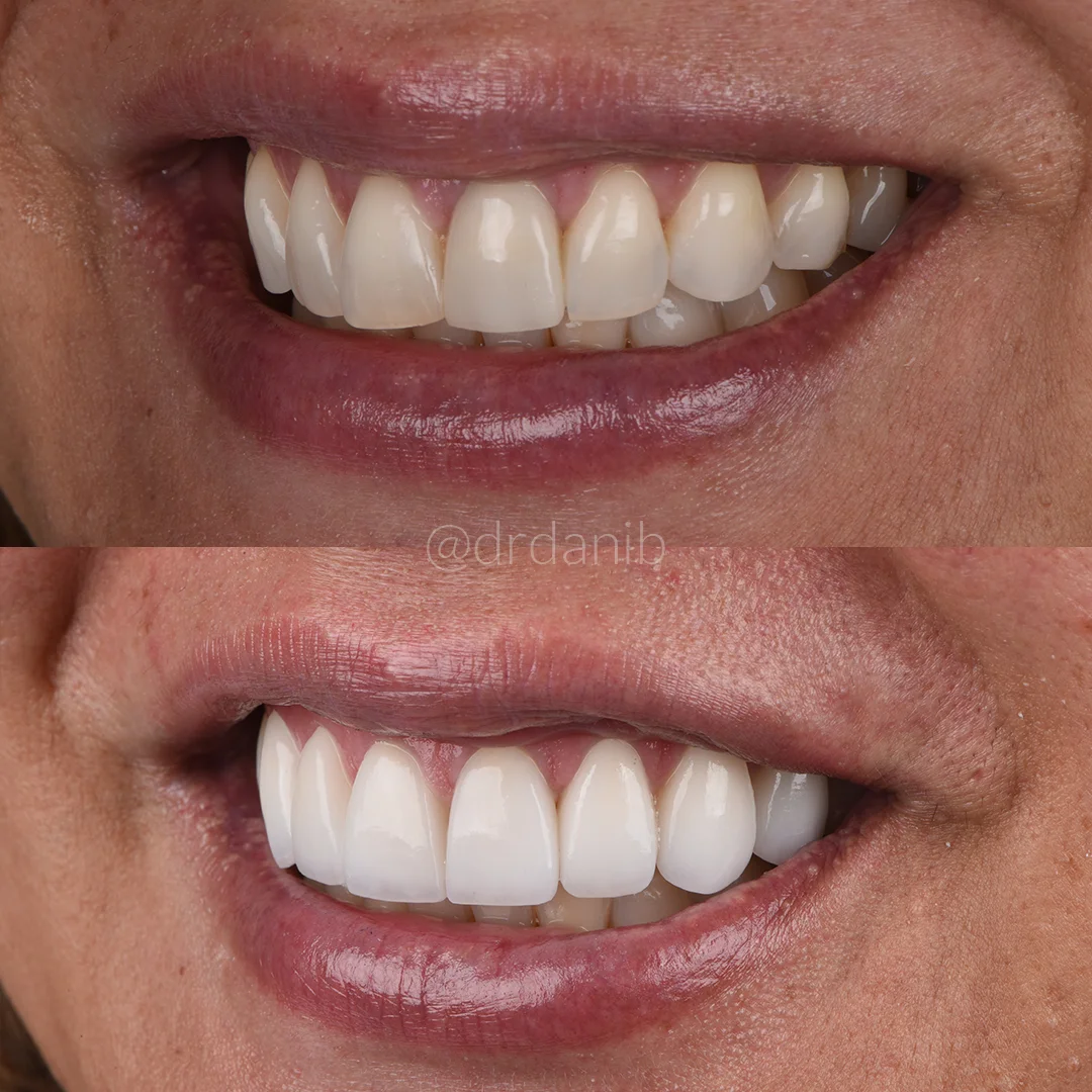 Veneers Before & After los angeles By Dr. Dani B
