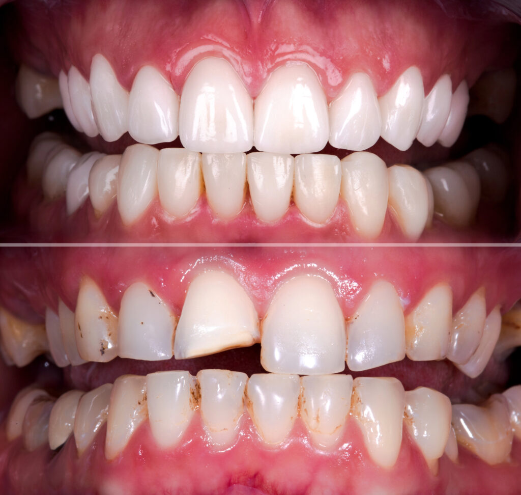 Before-and-after smile transformation from cosmetic dentistry in Los Angeles - Dr. Dani B.