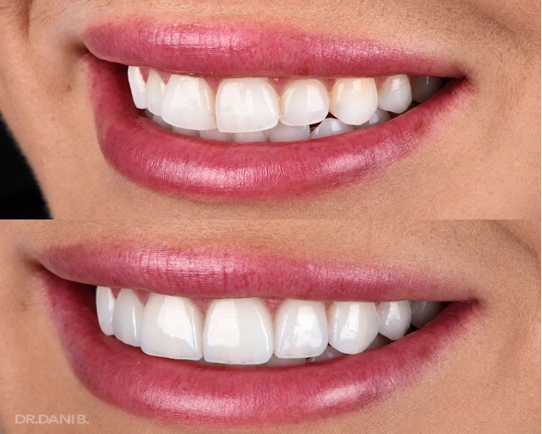 Before-and-after smile comparison illustrating how No-Prep Veneers in Los Angeles, CA may improve tooth shape, symmetry, and overall smile appearance